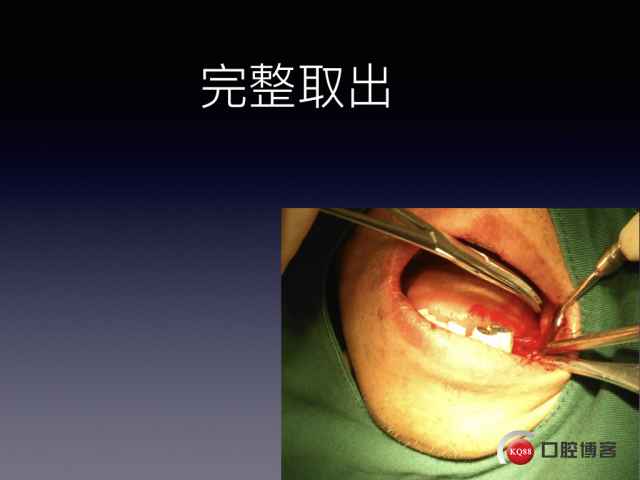 超级囊肿摘除_kq88口腔外科网