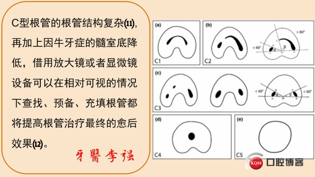 牛牙症遇到c型根管