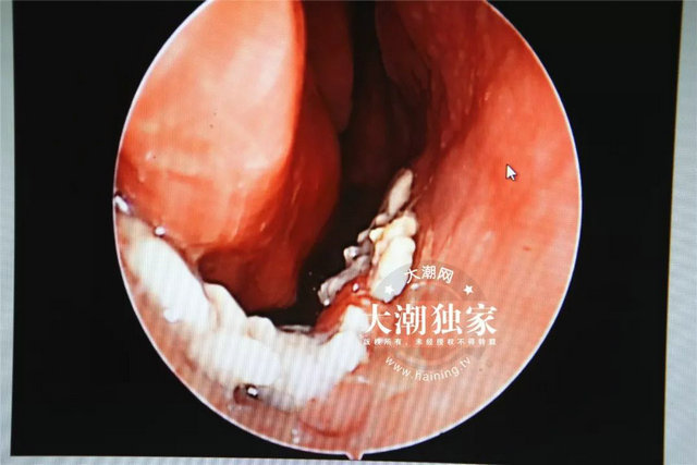整个鼻底都被一层白白的"肿物"覆盖了,表面不光滑,还有红红的肉芽样