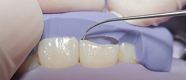 一例上前牙美学树脂直接修复
