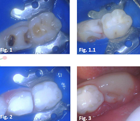 炎性活髓保存治疗年轻恒牙根尖周炎一例