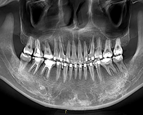 转诊病例：重度露龈笑，高角凸面型的拯救