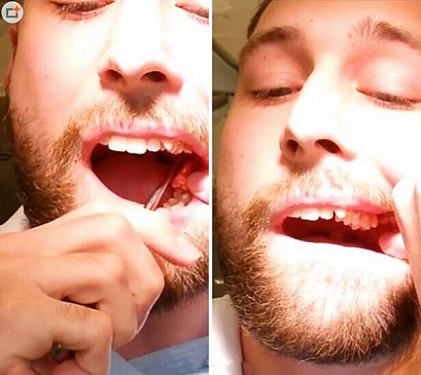 切勿模仿!丹麦医学院学生给自己拔牙血腥不忍直视