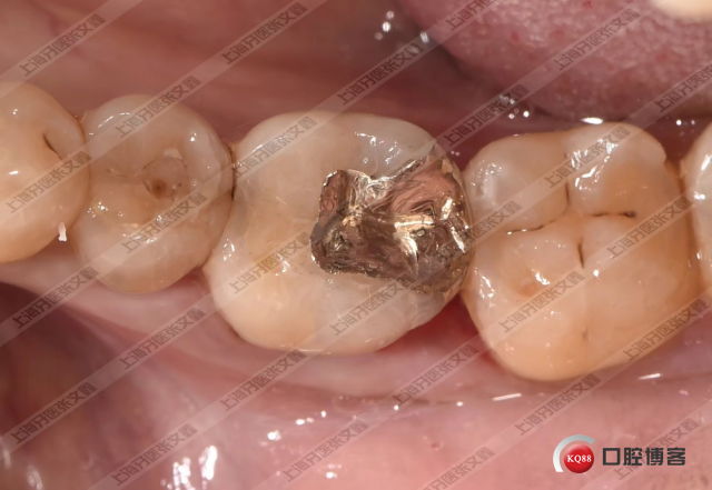 我就在那默默的做着我的金嵌体