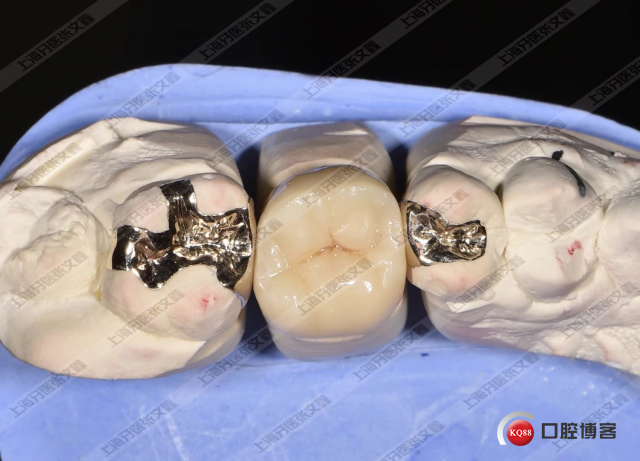 我就在那默默的做着我的金嵌体