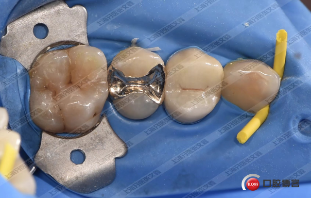 我就在那默默的做着我的金嵌体