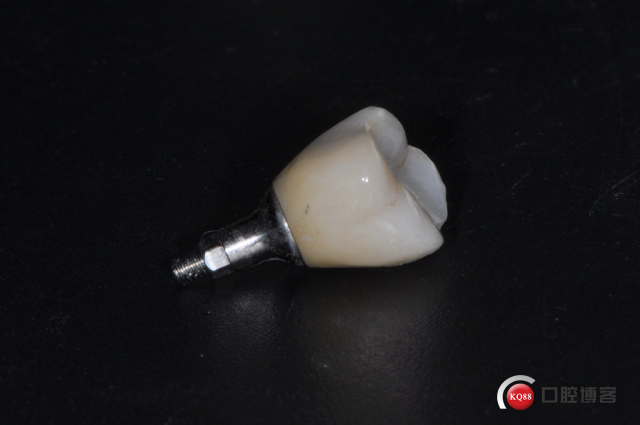 图21  修复基台 牙冠颌面照