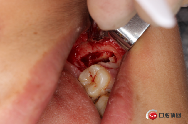 左下水平骨埋伏伴含牙囊肿智齿拔除