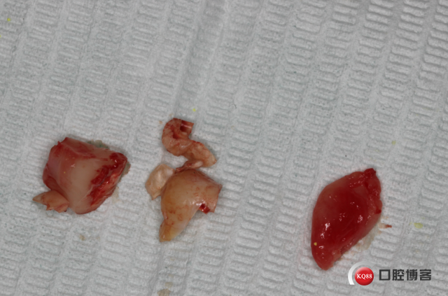 左下水平骨埋伏伴含牙囊肿智齿拔除