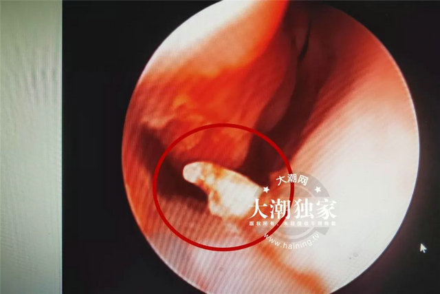浙江一男子鼻子里竟长出牙齿上面还布满密密麻麻的结石