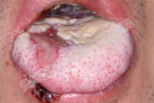 小伙全口溃烂,贵医附属口腔医院牙周黏膜科开通绿色通道后一周痊愈