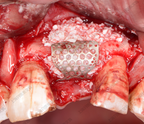 【病例展示】——上颌门牙GBR后种植修复案例